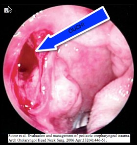 Oropharyngeal Trauma