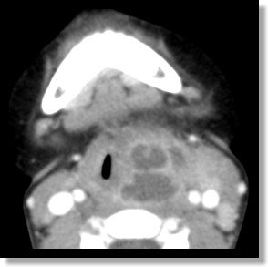 Retropharyngeal Abcess
