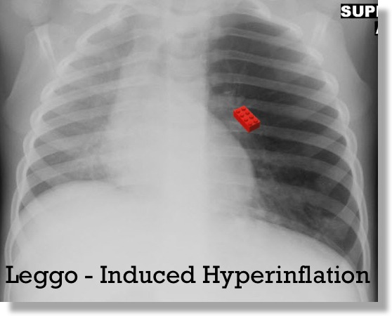 Foreign objects in chest X-rays