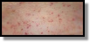 Is petechiae a symptom of leukemia?