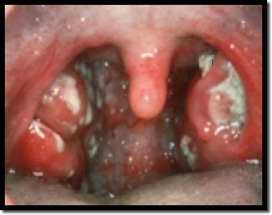 mononucleosis throat