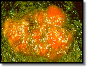 A) Clinical image showing kerion type of inflammatory tinea