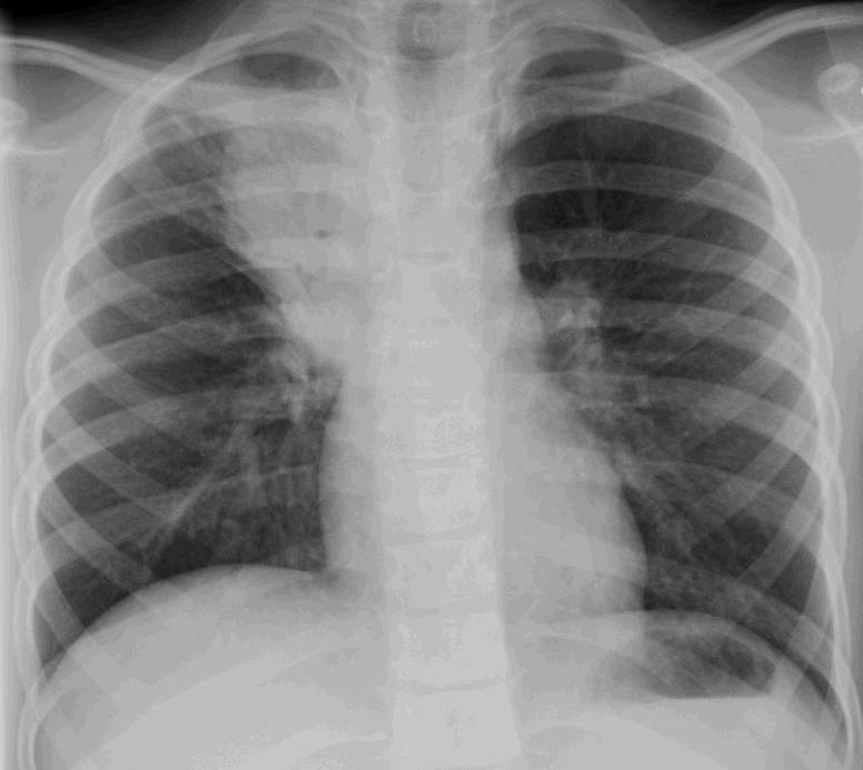 Pneumonia EGF