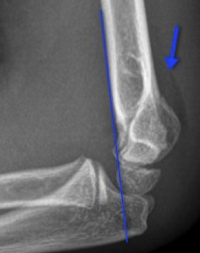 Supracondylar Fracture.