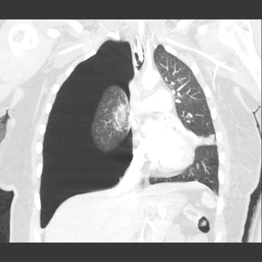 trauma pneumothorax chest tube