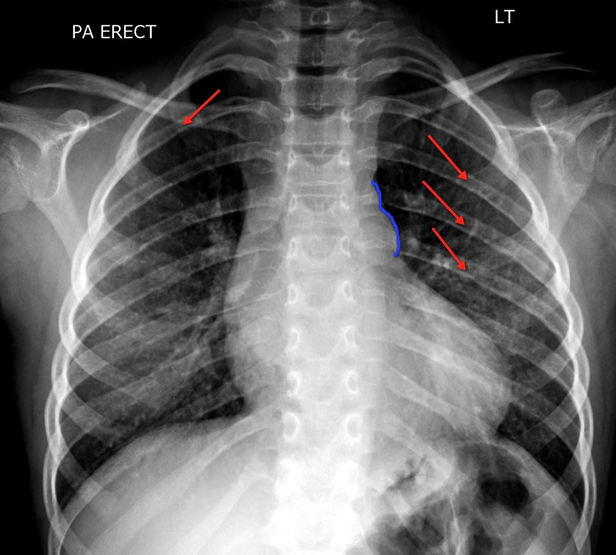 Coarctation Of The Aorta In Children