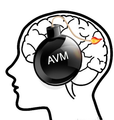 AVM