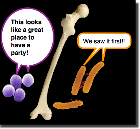 Osteomyelitis