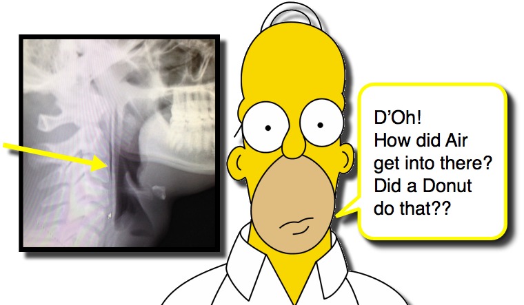 Pneumomediastinum