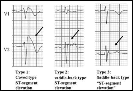 Brugada in Children