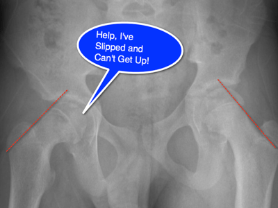 slipped capital femoral epiphysis vs legg calve perthes disease