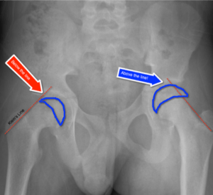 Scfe Line Slipped Capital Femoral Epiphysis — Pediatric EM Morsels