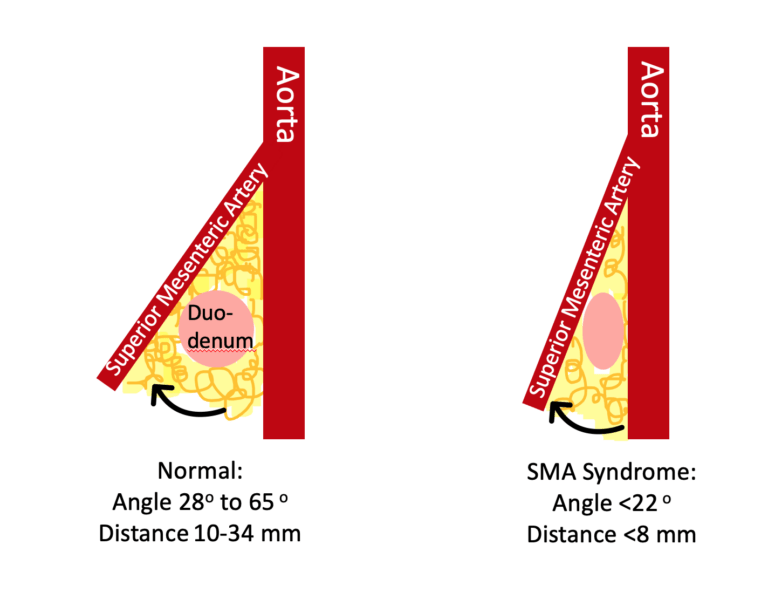 Superior Mesenteric Artery Syndrome SMA Syndrome In Children 