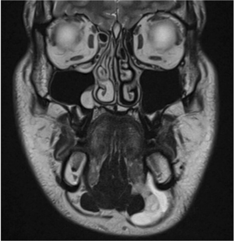 Pediatric Ranula Plunging Ranula — Pediatric EM Morsels
